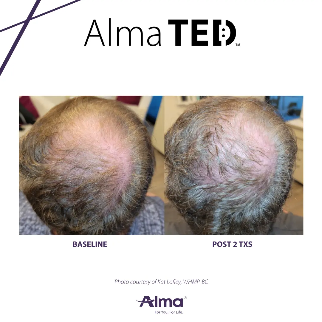 Hair Restoration Cost 1 ALMA TED HAIR RESTORATION