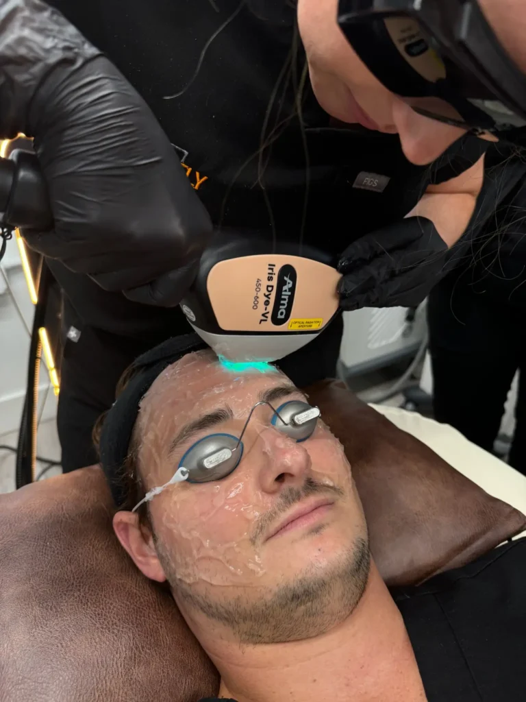 Alma DyeVL in Tampa at Perfectly Bare Laser Tampa MedSpa