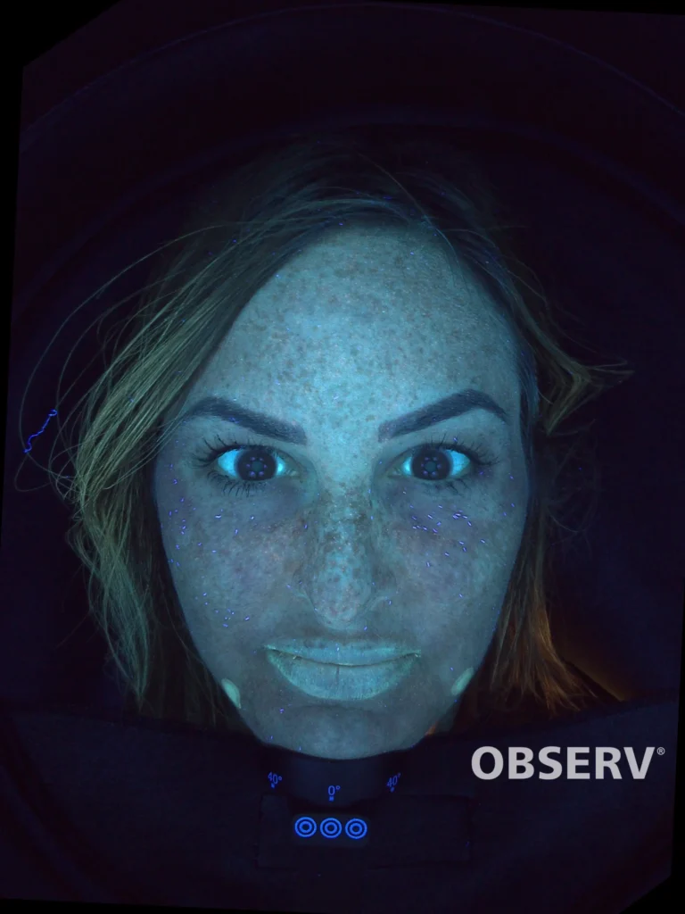 Alma IQ to analyze Rosacea