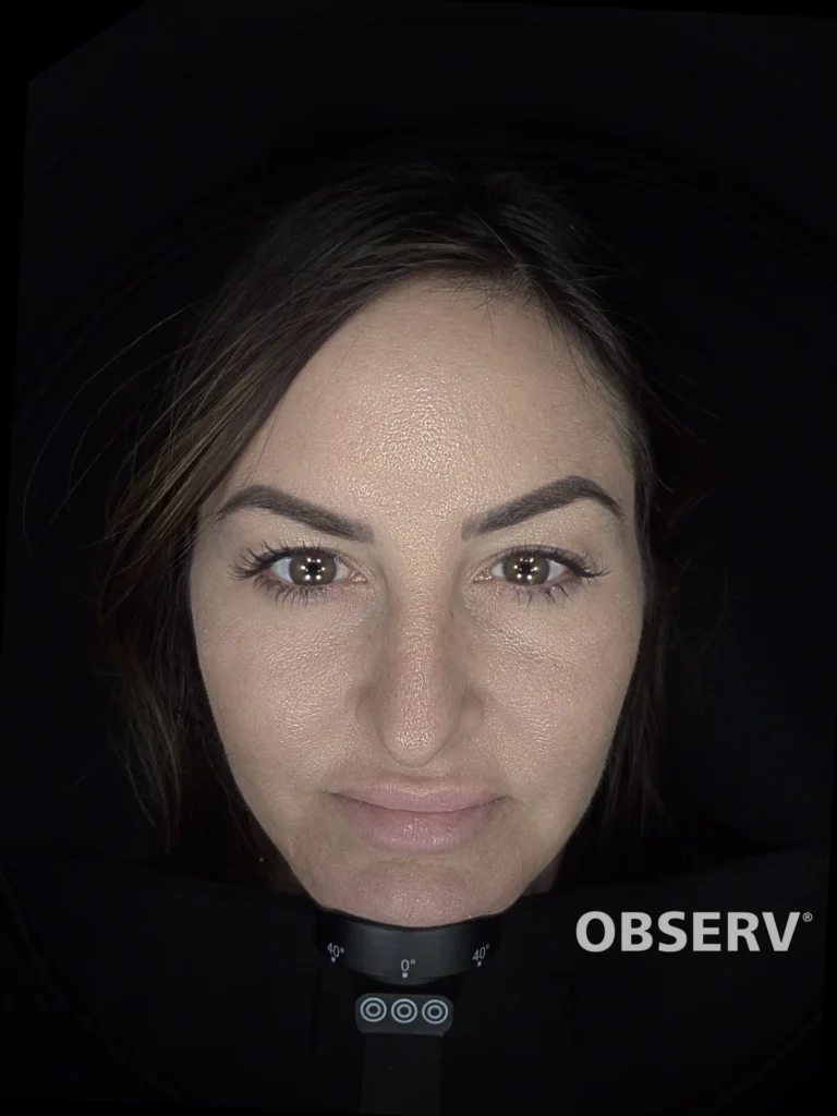 Alma IQ to analyze Rosacea