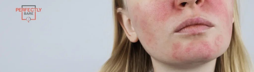 Best Rosacea Treatments options Near Me: HoBest Rosacea Treatments options Near Me