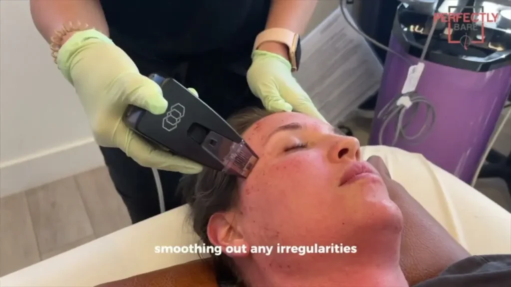 Reclaiming Your Glow: Why Morpheus8 in Tampa is the Ultimate Skin Solution 2 Discovering Morpheus Treatment in Tampa