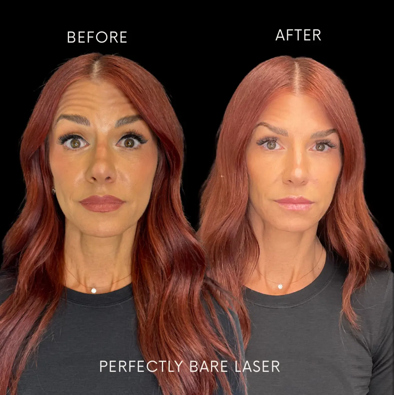 Home 6 At Perfectly Bare Laser, we believe in enhancing your appearance safely, subtly, and effectively — without surgery or extended downtime. That’s why I’m such a passionate advocate for cosmetic injections like Botox®, dermal fillers, and other non-surgical facial treatments.