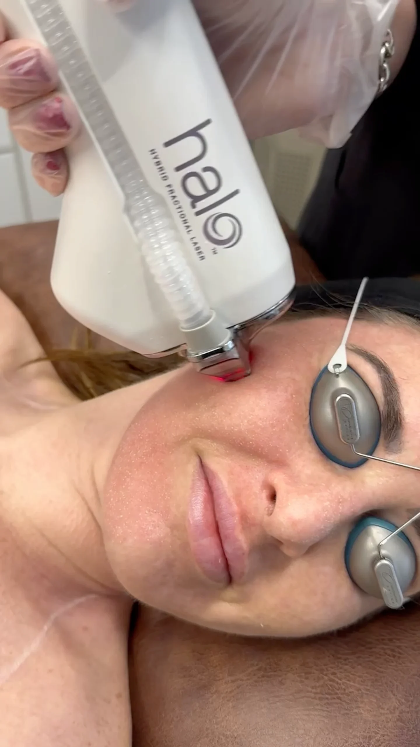 SCITON HALO Melasma Treatment in Tampa, FL
