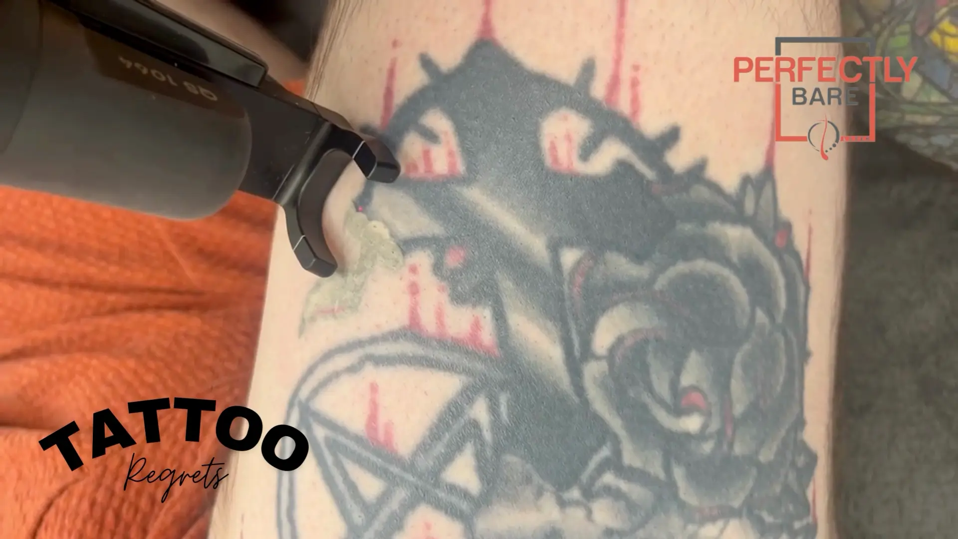 Laser Tattoo Removal At Perfectly Bare Laser