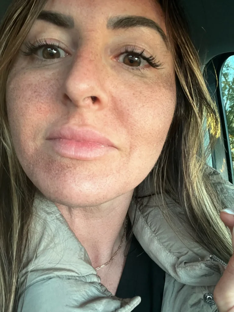 Radiant Skin with Sciton Halo Day 1 treatment