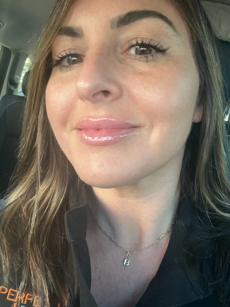 Sciton Day 7. The Sciton Halo Glow