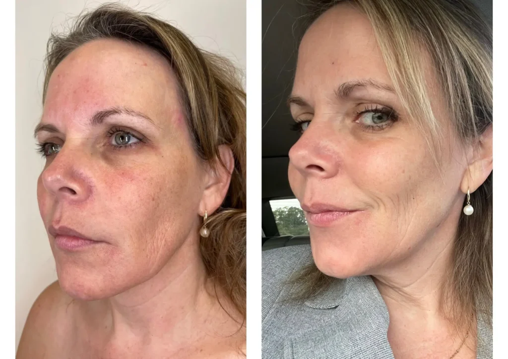 The Magic of Sciton Halo