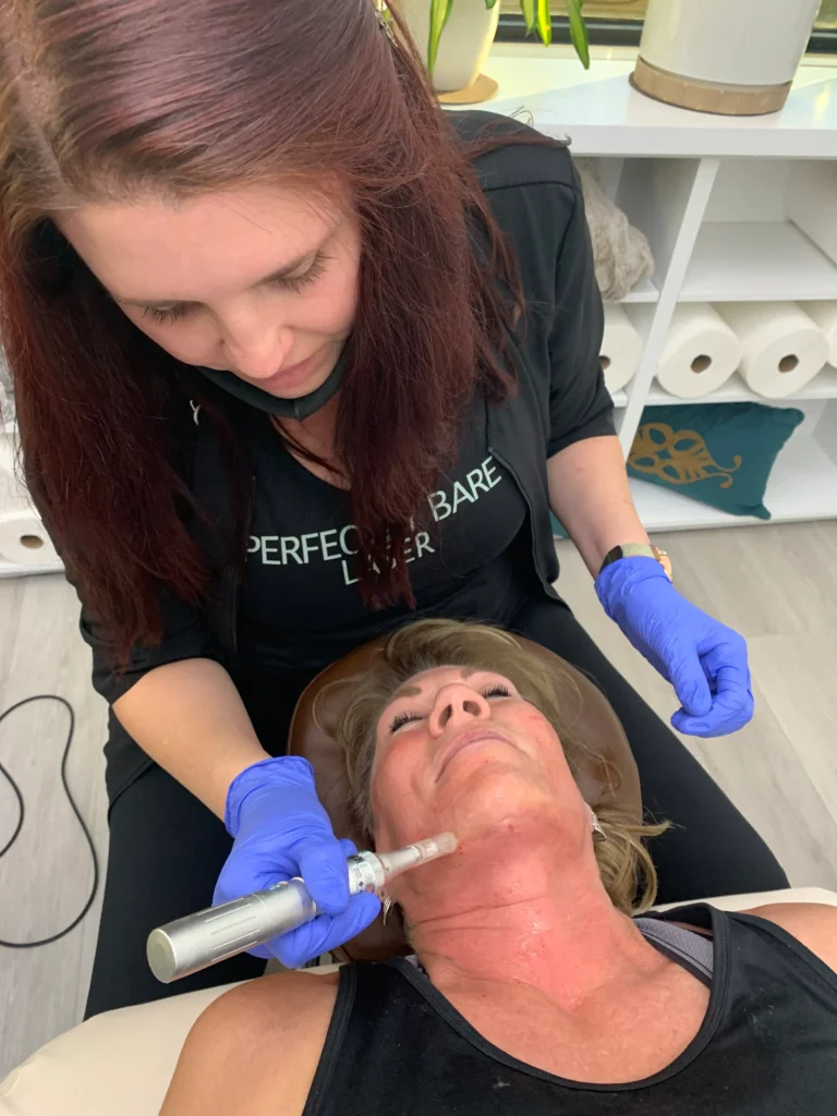 Unlocking Radiant Skin with Microneedling in Tampa