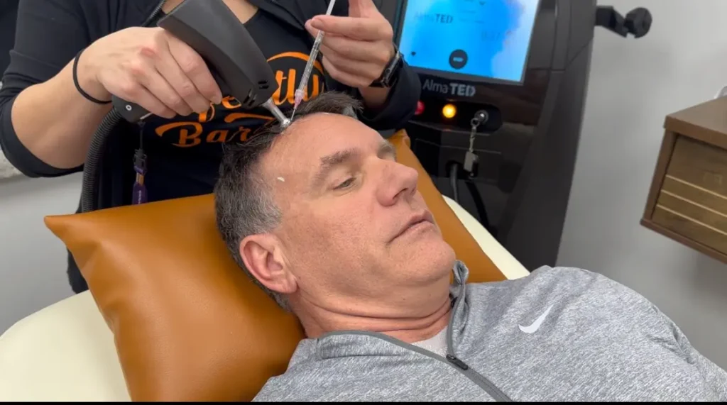 Unlocking the Future of Hair Restoration in Tampa with ALMA TED at Perfectly Bare Laser