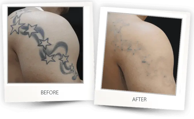 tattoo removal