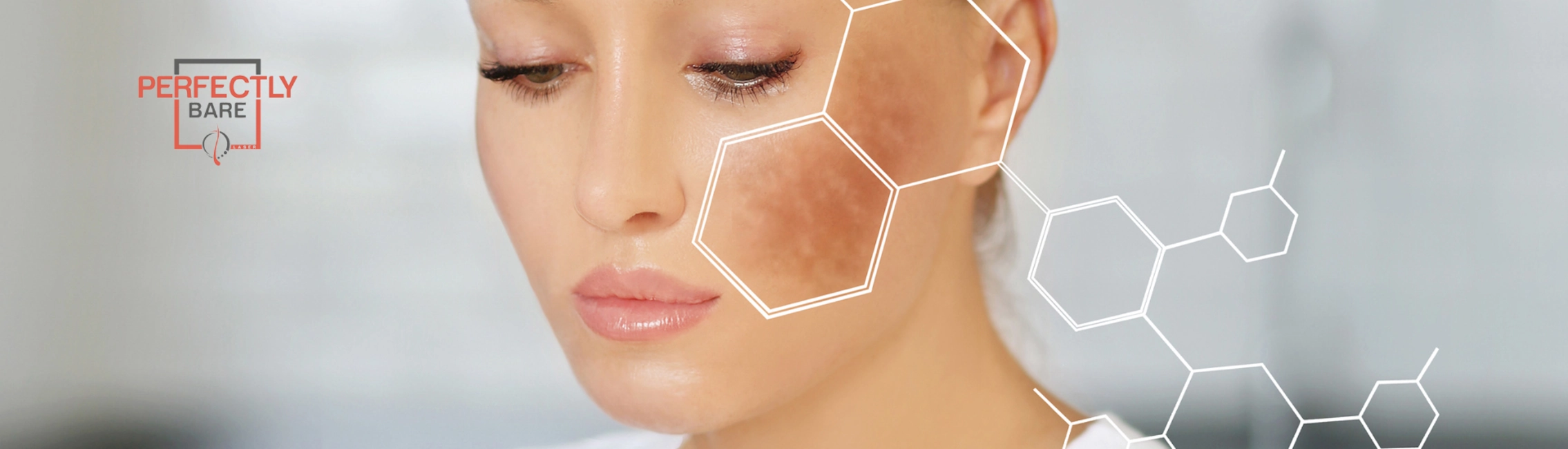 Melasma Treatment in Tampa, FL