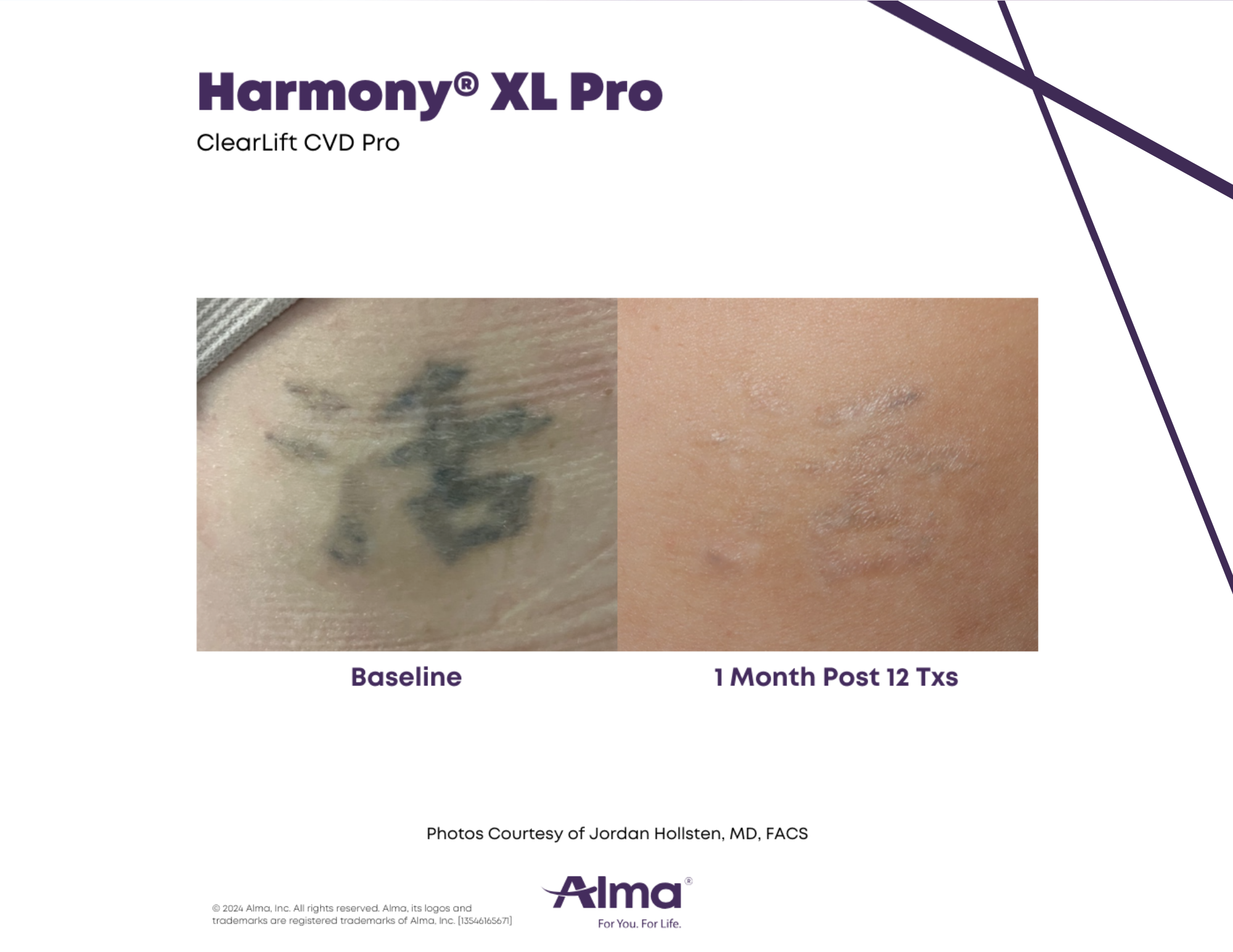 Tattoo Removal in Tampa