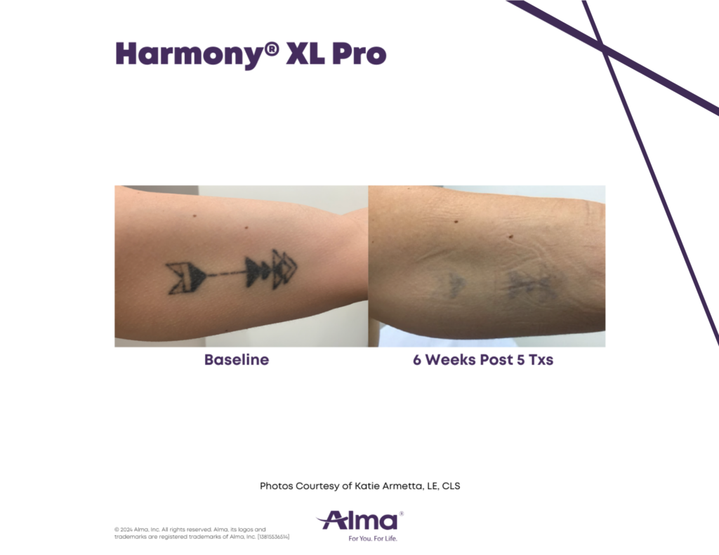 Laser Tattoo Removal in Tampa
