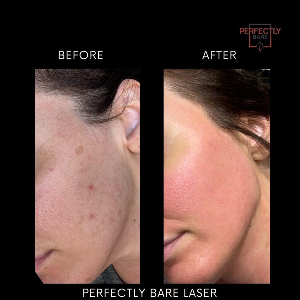 What causes acne? Inside Our New 8-Week Clinical Acne Protocol in Tampa 2 IMG 1693