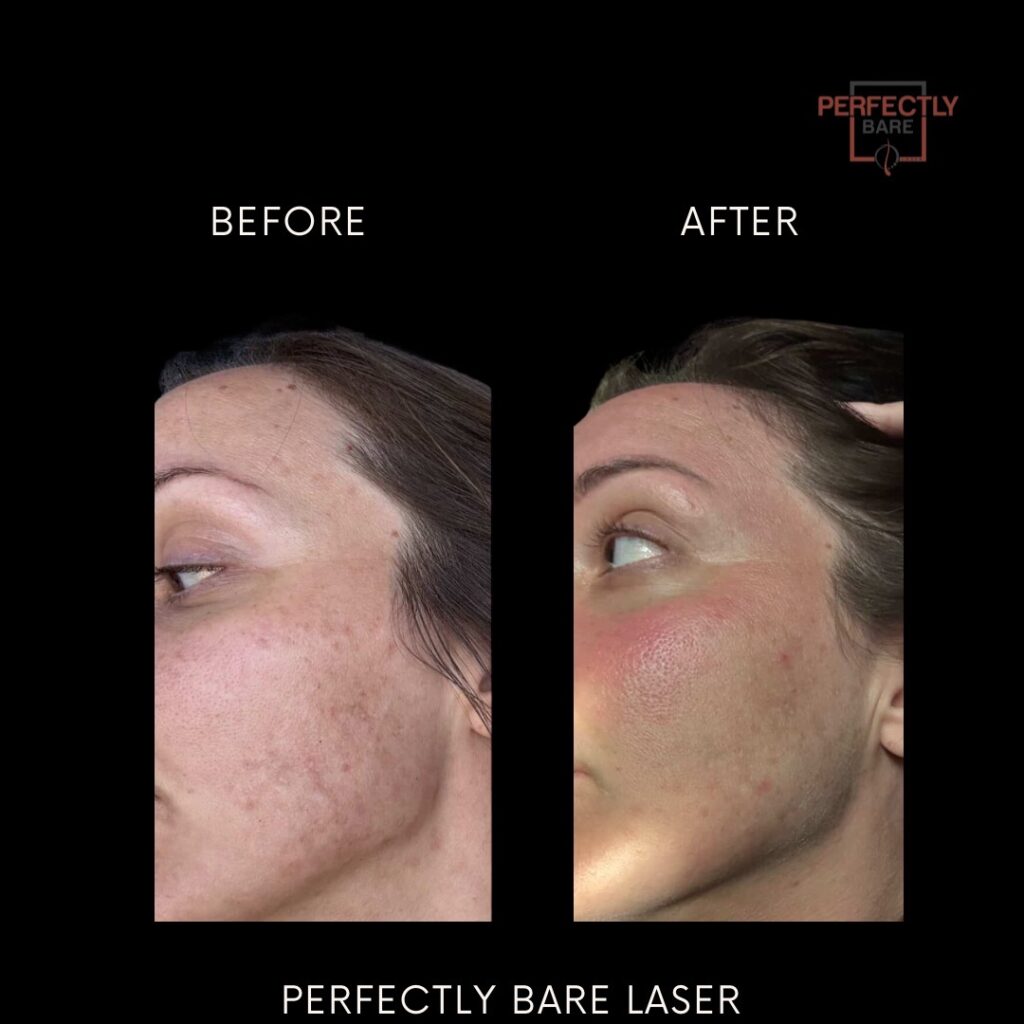 What causes acne? Inside Our New 8-Week Clinical Acne Protocol in Tampa 1 IMG 1696 2
