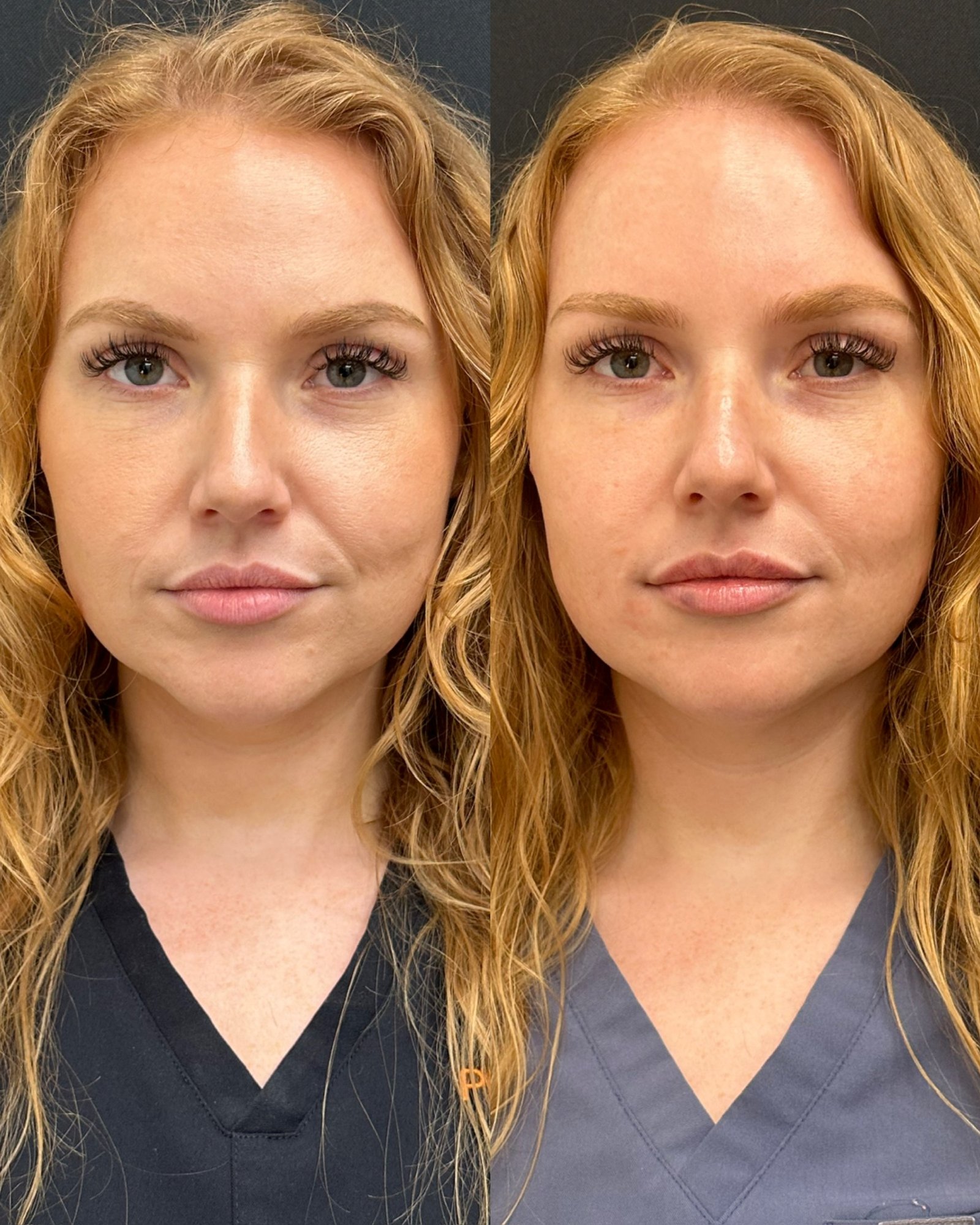 Home 2 Lip filler before and after in Tampa showing natural-looking volume, improved definition, and balanced lip shape.